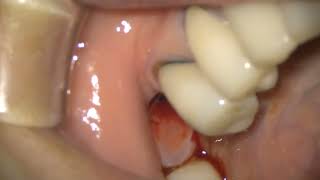 Straumann TLX in posterior mandible [upl. by Lefty]