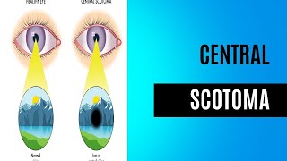 Central Scotoma  Visual Field Disorder [upl. by Eydnarb]