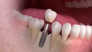 Straumann  Implantborne singletooth treatment [upl. by Idahs837]