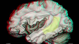 Fiber Pathways of the Cerebrum 3D Anaglyph [upl. by Dahs708]