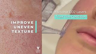 Fractional CO2 Laser Singapore  FAQ  Acne Scars Treatment [upl. by Gifferd864]