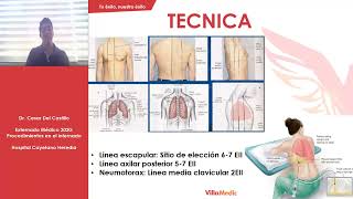 CLASE Nº8  Toracocentesis [upl. by Ducan]