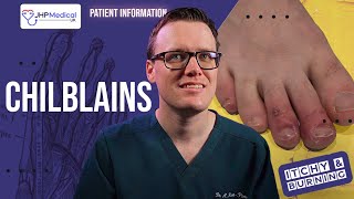 How To Get Rid Of CHILBLAINS Pernio Itchy Sores On Your Fingers And Toes  Doctor Explains [upl. by Norina]