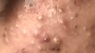 Huge Acne Pimples Blackheads Popping Up Satisfying with Oddly Calm Music [upl. by Romine656]