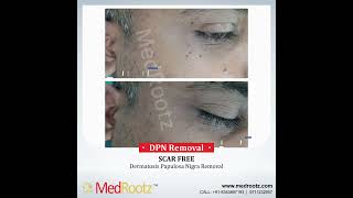 Dermatosis Papulosa Nigra Removal  Best Laser Treatment For DPN  DrAnujSaigal​​  MedRootz [upl. by Vanderhoek]