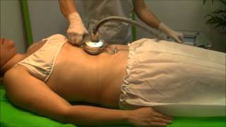 RADIO FRECUENCIA TRIPOLAR FACIAL [upl. by Nema]