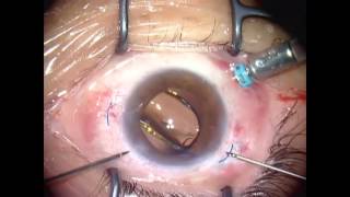 Sutureless intrascleral intraocular lens fixation – Supplementary Video ID 101515 [upl. by Derzon]