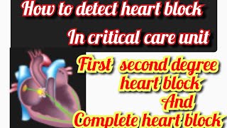 Heart block Atrioventricular block  AV block  ECG of heart block  mobitz type 1 and 2 [upl. by Suivatnad]