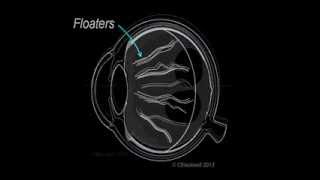 Vitreous 1 Vitreous Aging and Floaters [upl. by Arihay]