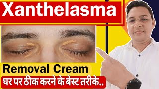 Xanthelasma Removal Cream  How to treat Xanthelasma home Remedies [upl. by Devinna444]