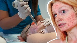 Getting Acne  Scarring LASER Treatment [upl. by Bendicty109]