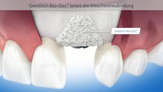 3DAnimation Zahnmedizin Alveolarwanddefekt Knochenaufbau Oberkiefer GEISTLICH [upl. by Dyal]