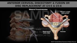 Anterior Cervical Discectomy amp Fusion or Disc Replacement at C45 amp C56 [upl. by Amsirak569]