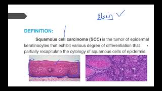 Squamous Cell Carcinoma [upl. by Julie]