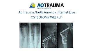 OSTEOTOMY WEEK 1 April 18  Deformity Evaluation [upl. by Stewardson]