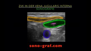 Sonographie  ZVK in der Vena jugularis interna [upl. by Doria]