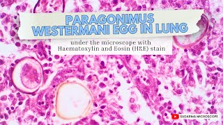 Paragonimus westermani egg in Lung under the microscope with Haematoxylin and Eosin HampE stain [upl. by Louisa]