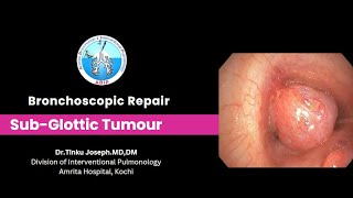 Subglottic Airway Tumour  Bronchoscopic management [upl. by Jeb]