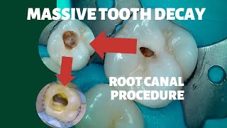 112 Massive Cavity Results in Root Canal Full Procedure [upl. by Milka]