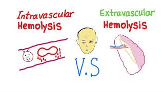 Intravascular Vs Extravascular Hemolytic Anemia Whats The ACTUAL Difference [upl. by Eilac260]