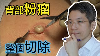 背部粉瘤  粉瘤取出  微創  表皮樣囊腫  Dermatologist  Back epidermoid cyst  角蛋白  皮膚活檢手術  皮膚專科 [upl. by Nywg]