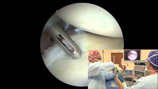 Arthroscopic Posterior Labral Repair  Randy S Schwartzberg MD [upl. by Stearn]