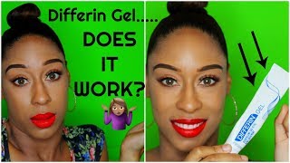 HOW TO USE DIFFERIN GEL DOES DIFFERIN GEL REALLY WORK 🤷🏾‍♀️ [upl. by Claudelle]