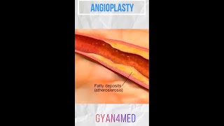 Coronary angioplasty Femoral Access [upl. by Lesly]