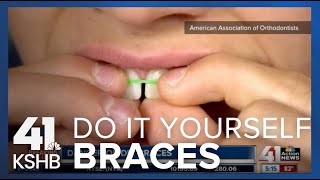 DIY Braces [upl. by Alit]