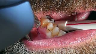 Easy Tooth Extraction  Dental Minute with Steven T Cutbirth DDS [upl. by Assira]