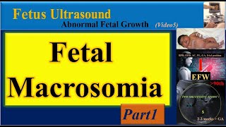 Fetus Ultrasound Fetal Macrosomia Part1 [upl. by Nirtiac]