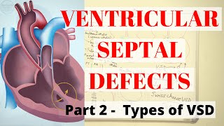 VENTRICULAR SEPTAL DEFECTS PART 2 Types of VSD [upl. by Feinberg781]