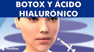 Ácido hialurónico en la cara o botox  Tratamiento ANTIARRUGAS y líneas de expresión © [upl. by Aneg]