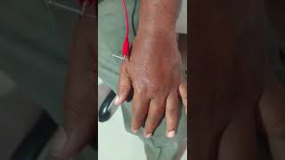 Carpal tunnel syndrome treatment by acupuncture needles [upl. by Doowyah]