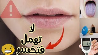 لون الشفاه أبيض ؟ معلومه قد تنقذ حياتك [upl. by Atalee]