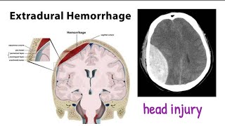 extradural hematoma  head trauma 1 headinjury [upl. by Ggerg954]