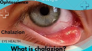 What is chalazion  what causedchalazion  Is chalazion a stye [upl. by Yoral243]