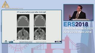 ERS London 2018 Novel Treatments For CRSwNP Claus Bachert [upl. by Lilla321]