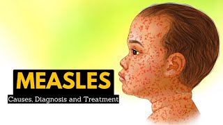 Measles Causes Signs and Symptoms Diagnosis and Treatment [upl. by Sesylu]