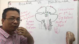 bulbar palsy vs pseudobulbar palsy [upl. by Obeng]