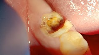 Badly Decayed Lower Molar Six Extraction By Straight Elevator [upl. by Beltran]