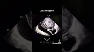 Severe Mitral Stenosis amp Atrial Thrombus Formation echocardiography echocardiogram cardiology [upl. by Stubstad]