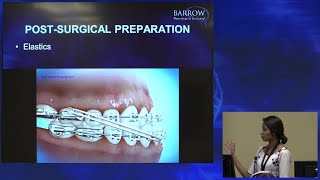 Role of Braces Before amp After Jaw Surgery [upl. by Rhine]