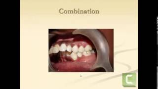 Classification of malocclusion [upl. by Roel]