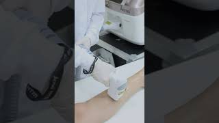 Ácrus da HTM epilação laser [upl. by Hsac]