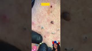 💙 Best Satisfying Blackhead Removal  Pimple Popping Blackheads amp White Heads Removal From Nose [upl. by Lukash]