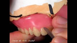 1  🔴 FORMAS DE LOS CUELLOS 🔴 en protesis total dental FESTONEADO [upl. by Evette808]