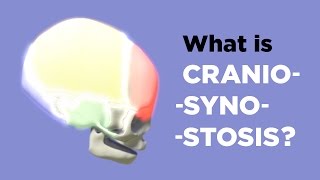 What is Craniosynostosis [upl. by Ling]