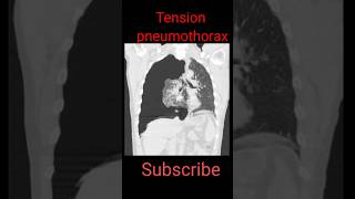 Tension Pneumothorax shorts radiological education chestpathology [upl. by Draned]