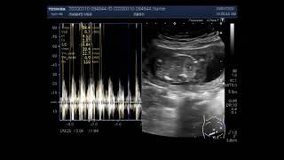 Anencephaly with a pregnancy of about 16 weeks [upl. by Eolc245]